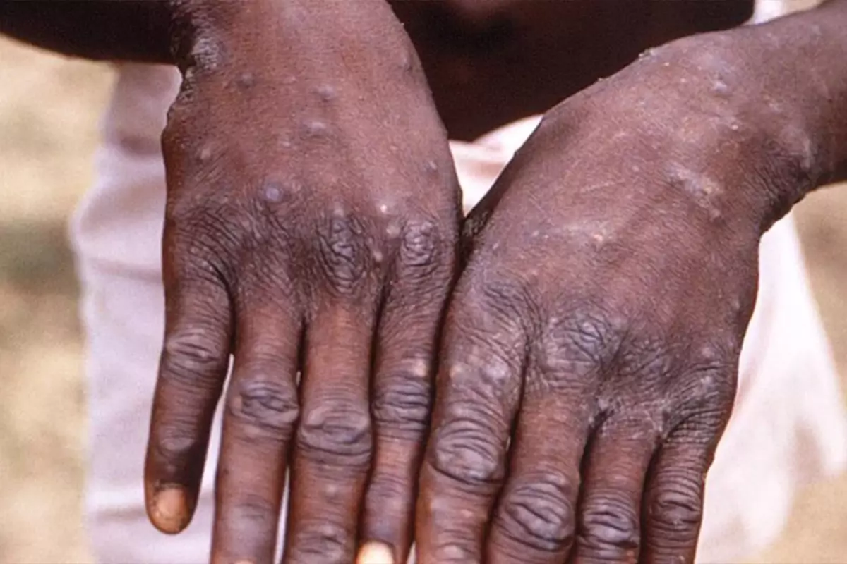 Afrika ülkesinde M çiçeği alarmı! Vakalar da can kaybı da arttı